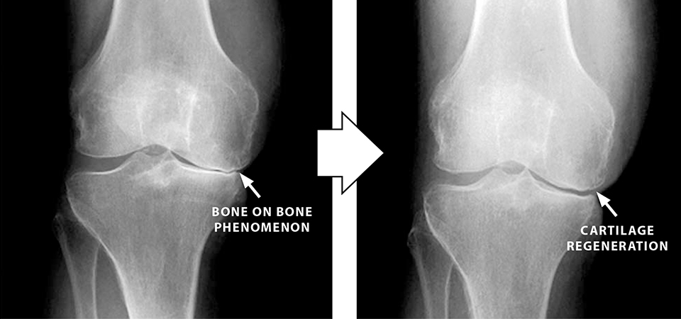 膝の痛みに再生医療